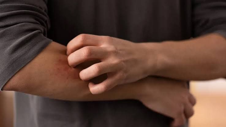 Aumento dei casi di dermatofilosi in Europa: Pregliasco rassicura sul basso rischio ma segnala nuove modalità di trasmissione